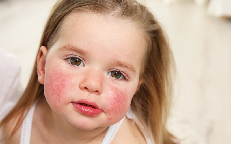 childrens allergies symptoms